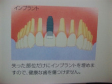 ●歯のインプラントo(^-^)o案外と大丈夫…
